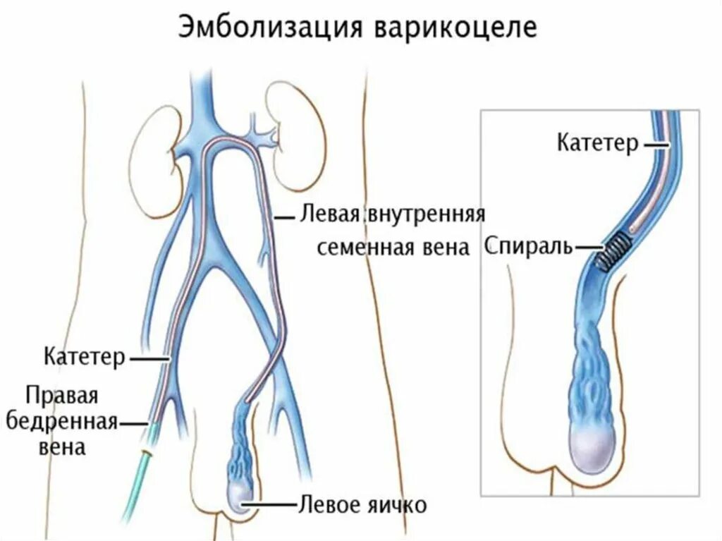 Расширение вены семенного канатика. Варикоцеле операция Мармара. Варикоз вен семенного канатика. Варикозное расширение вен семенного канатика (варикоцеле. Варикоцеле – расширение вен семенного канатика.