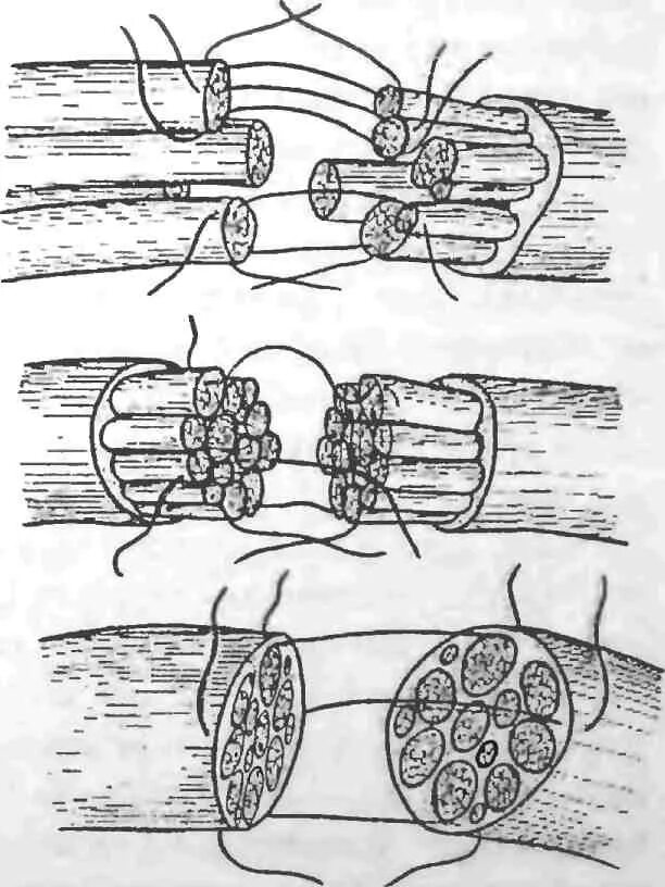 Сшивание нерва латынь. Эпиневральный шов нерва. Пластика нервных стволов. Пластика дефектов периферических нервных стволов:.