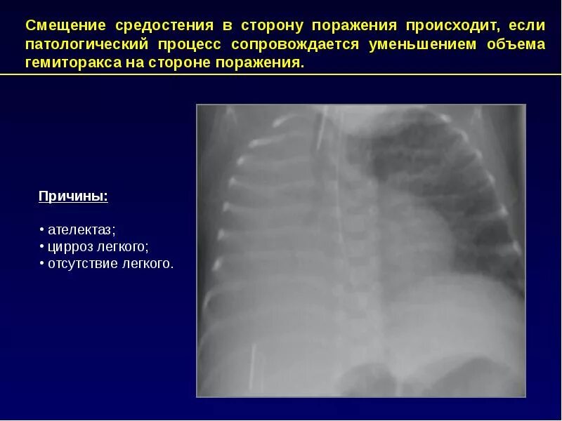 Смещение средостения в здоровую сторону