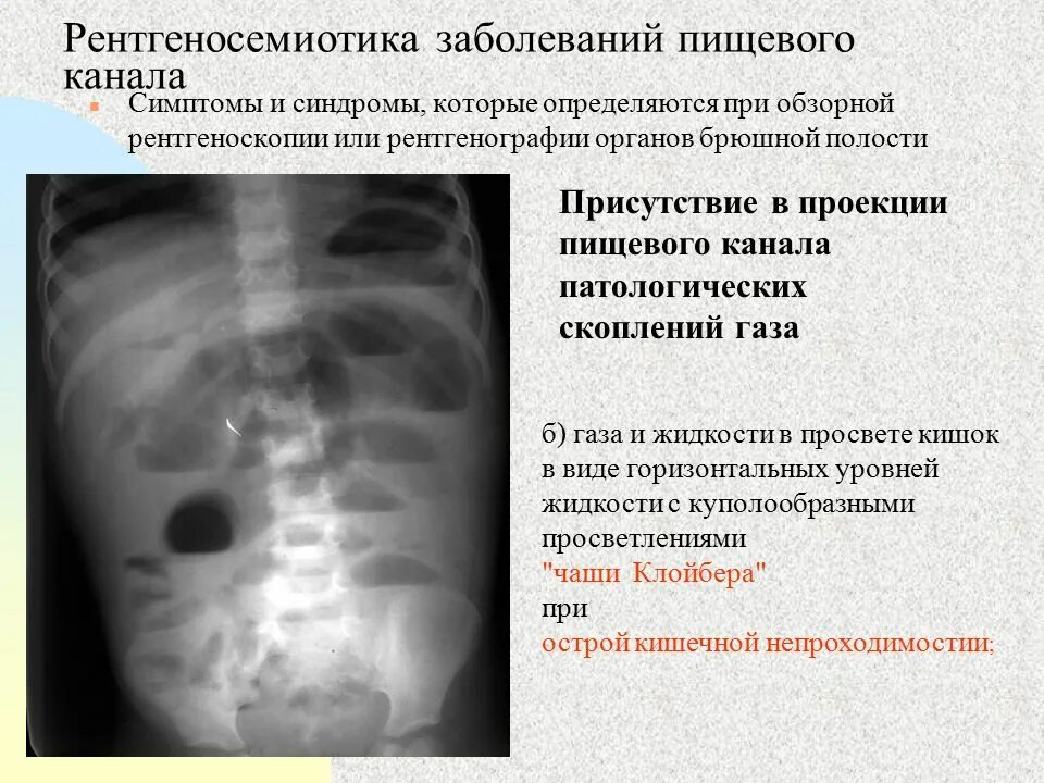 Тонкокишечная непроходимость рентгенография. Уровни жидкости на рентгене брюшной полости. Странгуляционная кишечная непроходимость ирригография. Кишечная непроходимость симптомы рентген.