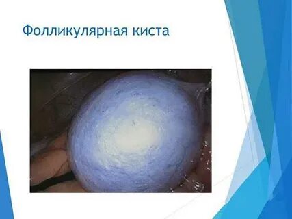 Киста у женщин причины образования