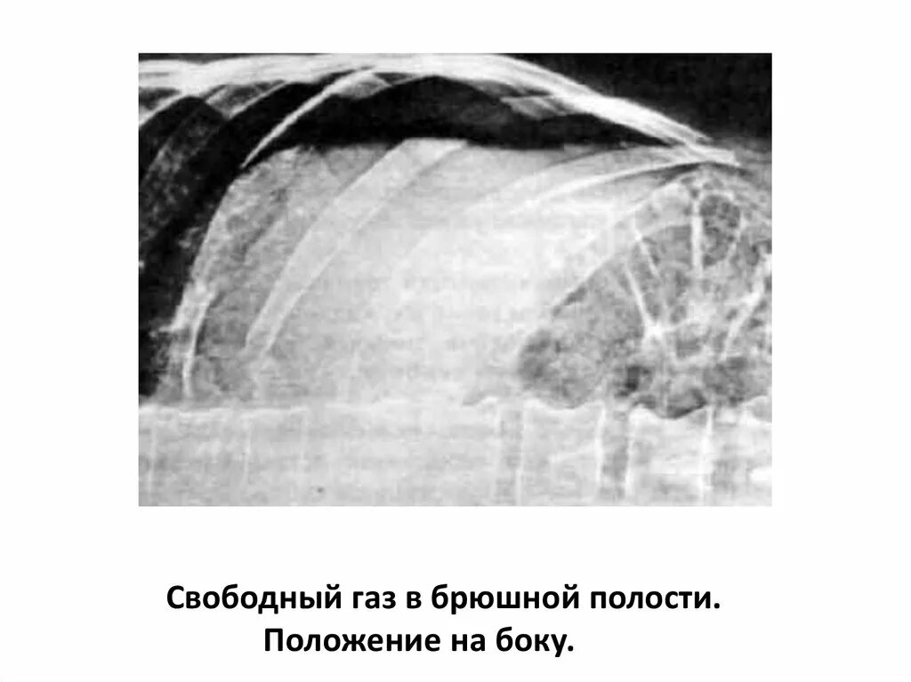Свободный газ нефть. Свободный ГАЗ В брюшной полости рентген латерограмма. Свободный ГАЗ В брюшной полости рентген на боку. Свободный ГАЗ В латеропозиции. Свободный ГАЗ В брюшной полости латеропозиция.