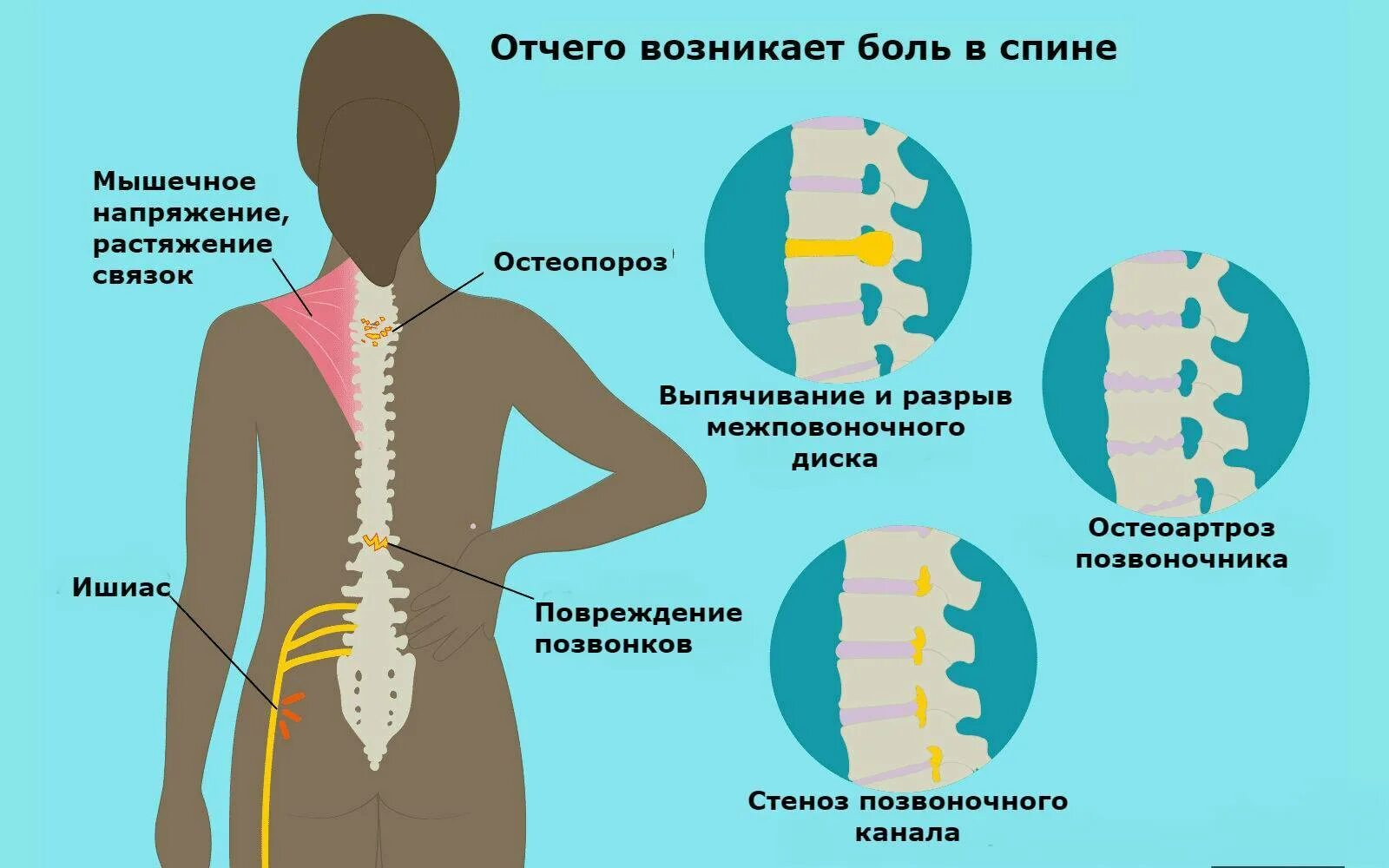 Колет внутри. Боль в спине. Болит спина. Болит позвоночник. Причины боли в спине.