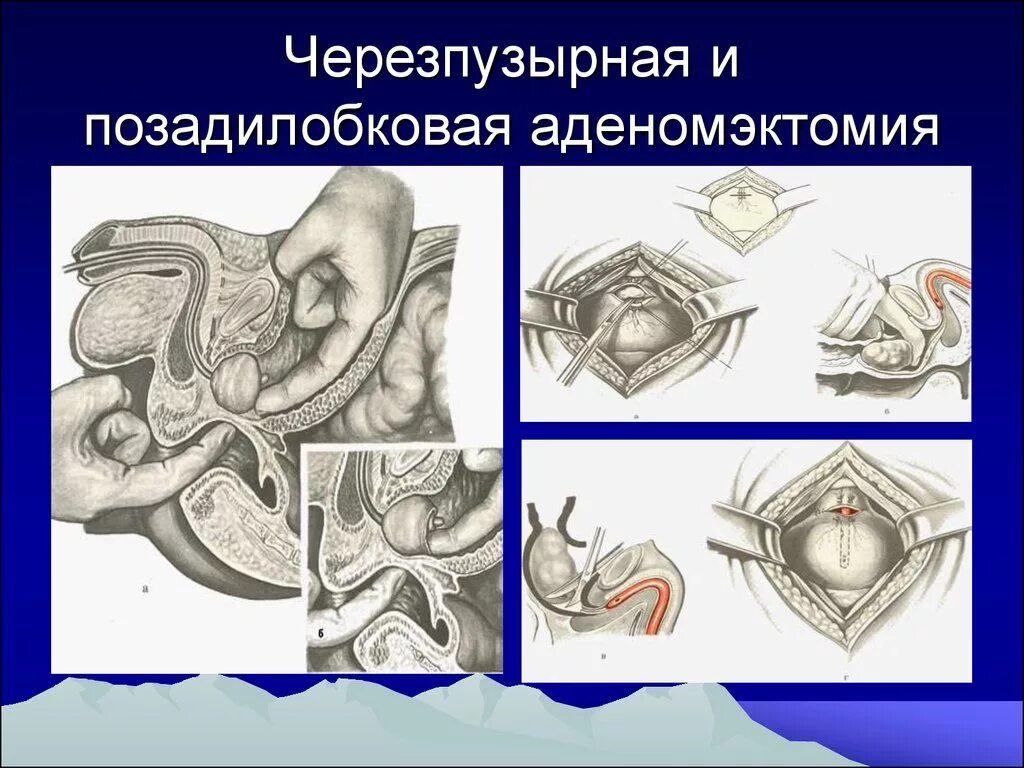 Простатэктомия простаты. Чрезпузырная аденомэктомия операция. Операция позадилонная аденомэктомия. Простатэктомия (аденомэктомия). Позадилобковая аденомэктомия простаты.