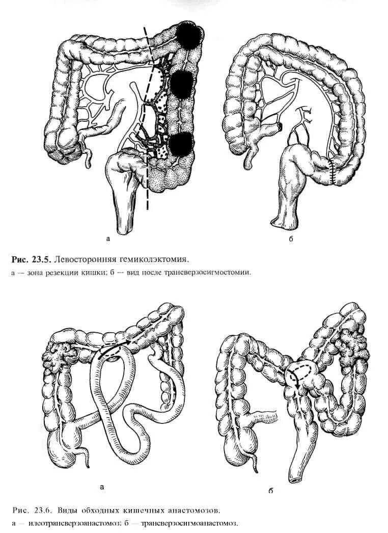 Операция толстой. Обходной анастомоз кишечника. Резекция сигмовидной и прямой кишки. Анастомоз Толстого кишечника. Левосторонняя гемиколэктомия.