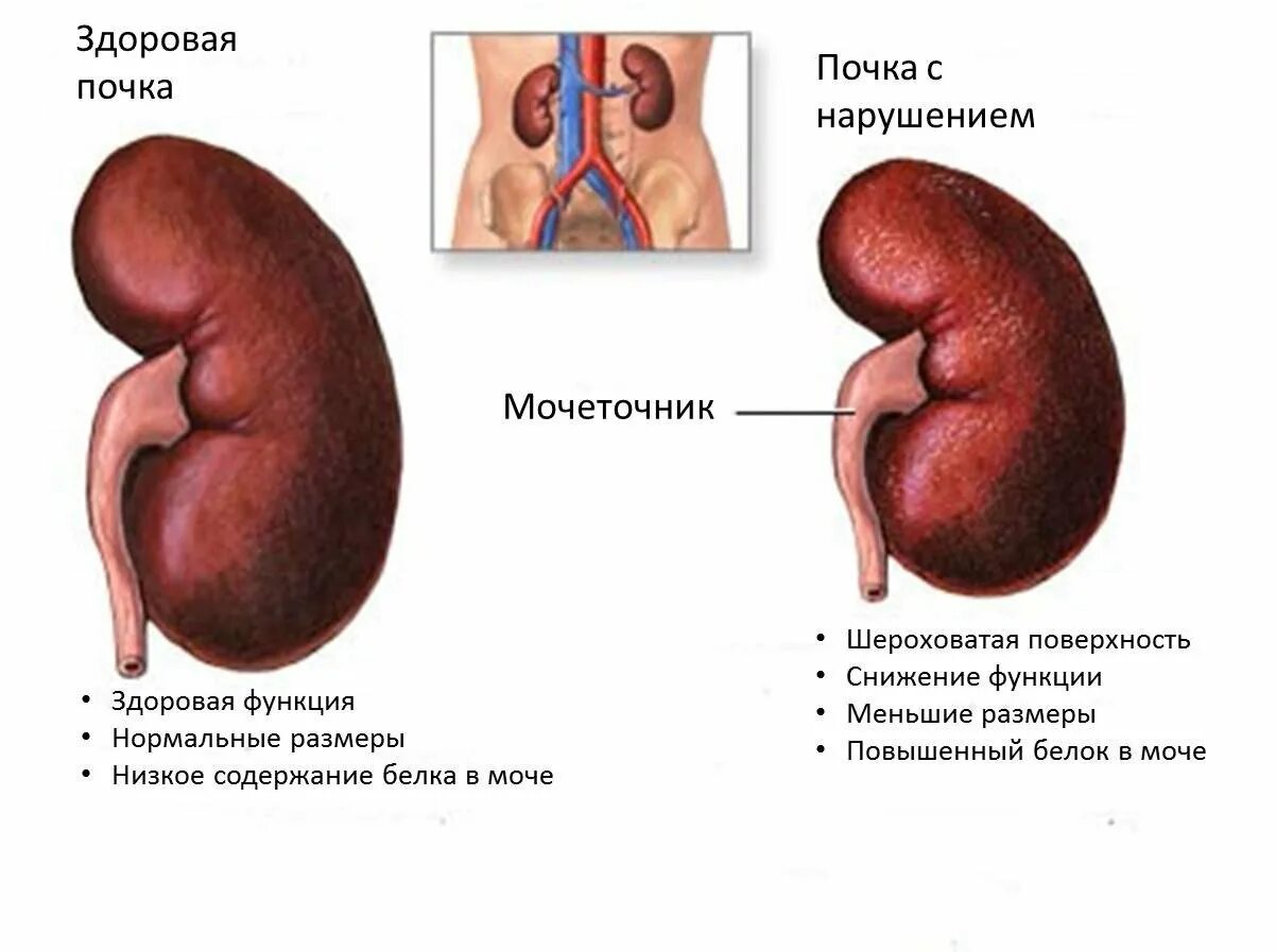 Почему плохие почки