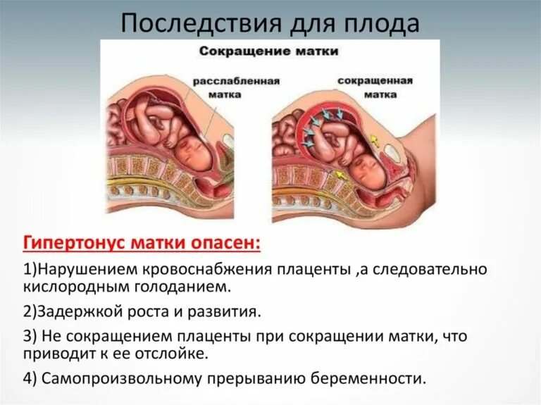 Гипертонус Матки Можно Заниматься Сексом