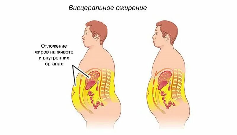 Легкое ожирение. Ожирение степень 1 степени у мужчин. Абдоминальное и висцеральное ожирение. Висцеральное ожирение 1 степени. Ожирение 1 степени висцеральный Тип.