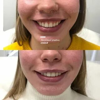 Улыбка ботокс