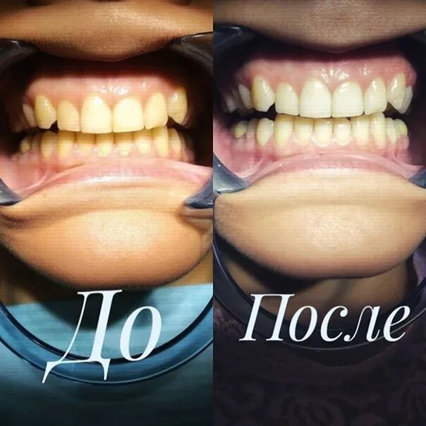 Teeth Oral Hygiene Essence Whitening Essence Daily Use Effective Remove Plaque S