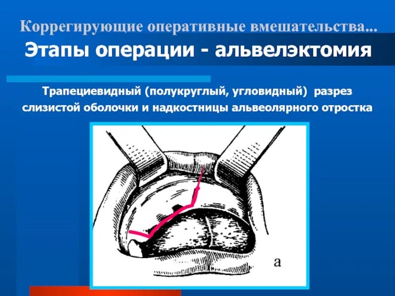 Слизисто надкостничный лоскут. Этапы оперативного вмешательства. Разрез слизистой оболочки. Назовите этапы операции