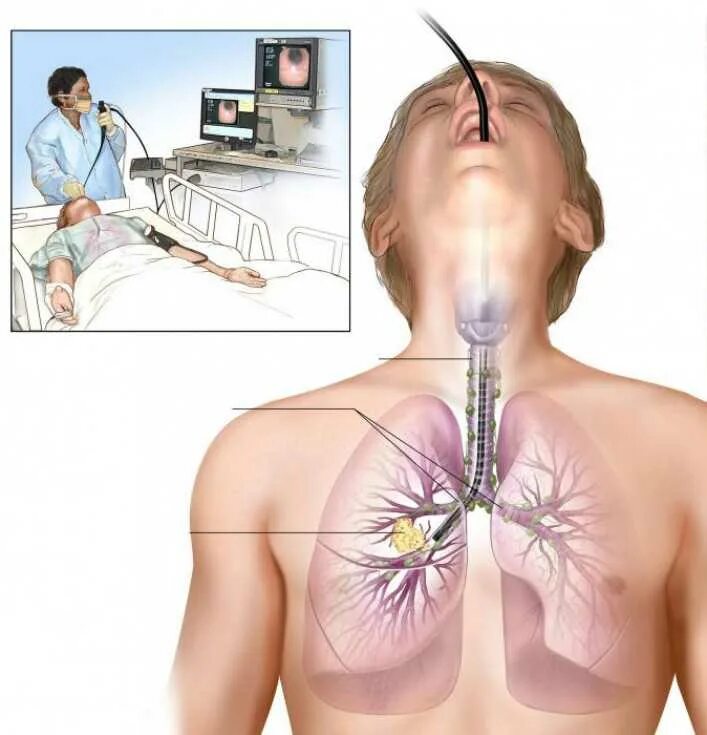 Бронхоскопия мокроты. Бронхоскопия и бронхография. Эндоскопическое исследование бронхов. Бронхоскопия метод исследования.
