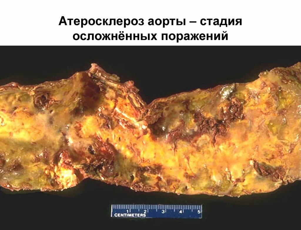 Атеросклероз аорты что это такое простыми. Атеросклероз аорты макропрепарат. атеросклероз аорты стадия атероматоза макропрепарат. атероматозно-язвенный атеросклероз аорты макропрепарат. атеросклероз аорты с тромбом макропрепарат.