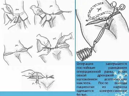 Бороться операция