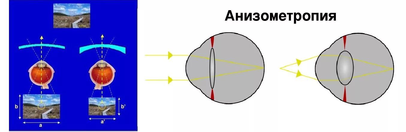 Анизометропия это в офтальмологии. Анизометропия и астигматизм. Анизометропия. Миопическая анизометропия. Гиперметропическая анизометропия.