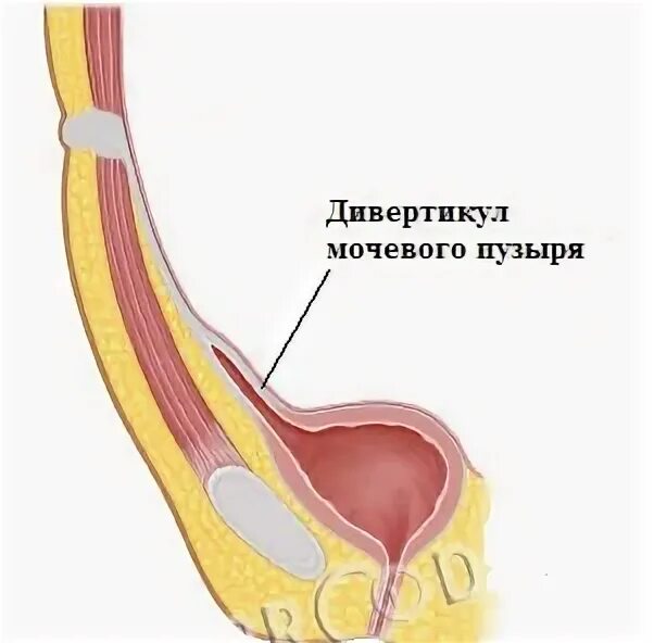 Уплотнение стенки мочевого пузыря. Дивертикул шейки мочевого пузыря. выпячивание стенки мочевого пузыря. дивертикул мочевого пузыря гистология. врожденный дивертикул мочевого пузыря.