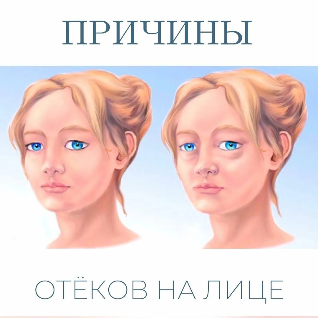 Почему отеки утром. Почему отеки утром