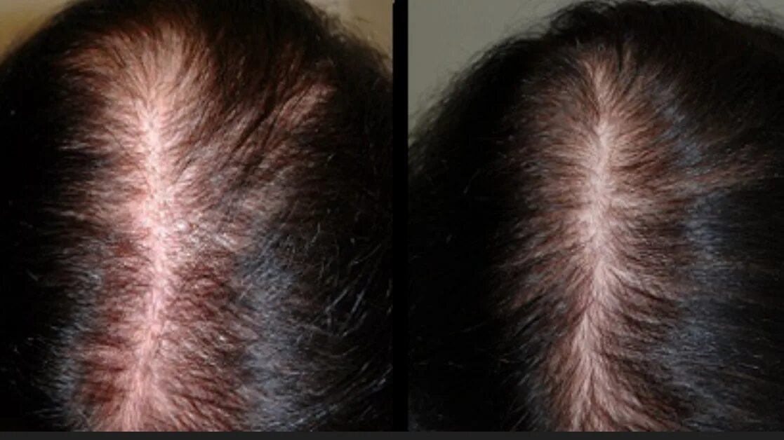 Усилить выпадение волос. Мезотерапия для волос. Выпадение волос до и после. Дарсонваль для волос до и после. Мезотерапия волос до и после.