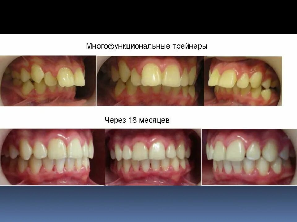 Аномалии трейнер. Элайнеры дистальный прикус. Глубокий прикус элайнеры. Глубокий прикус до и после брекетов.