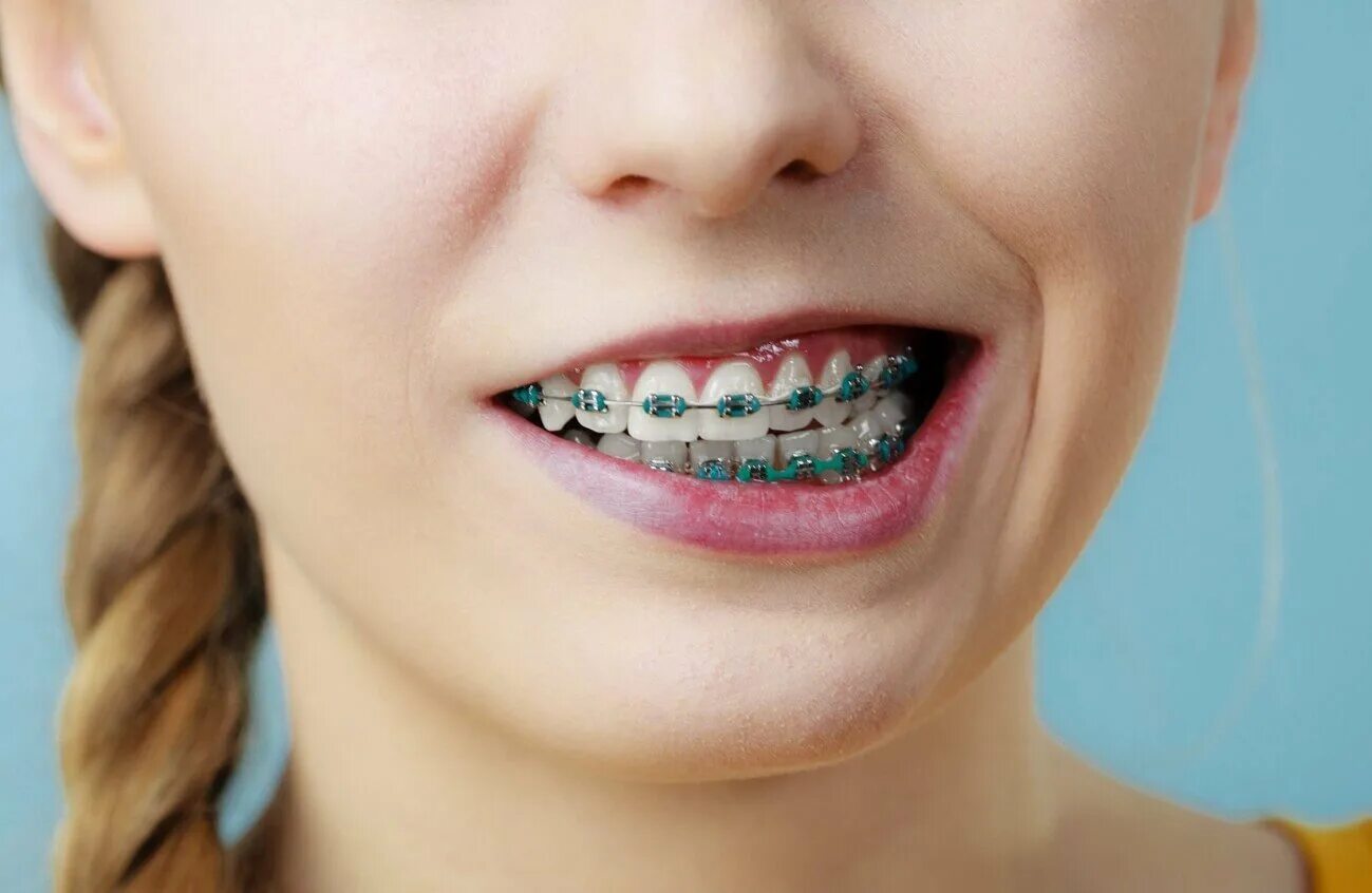 Что такое ортодонт. Брекеты. Брекеты для зубов. Разноцветные лигатуры для брекетов. Ортодонтические брекеты.