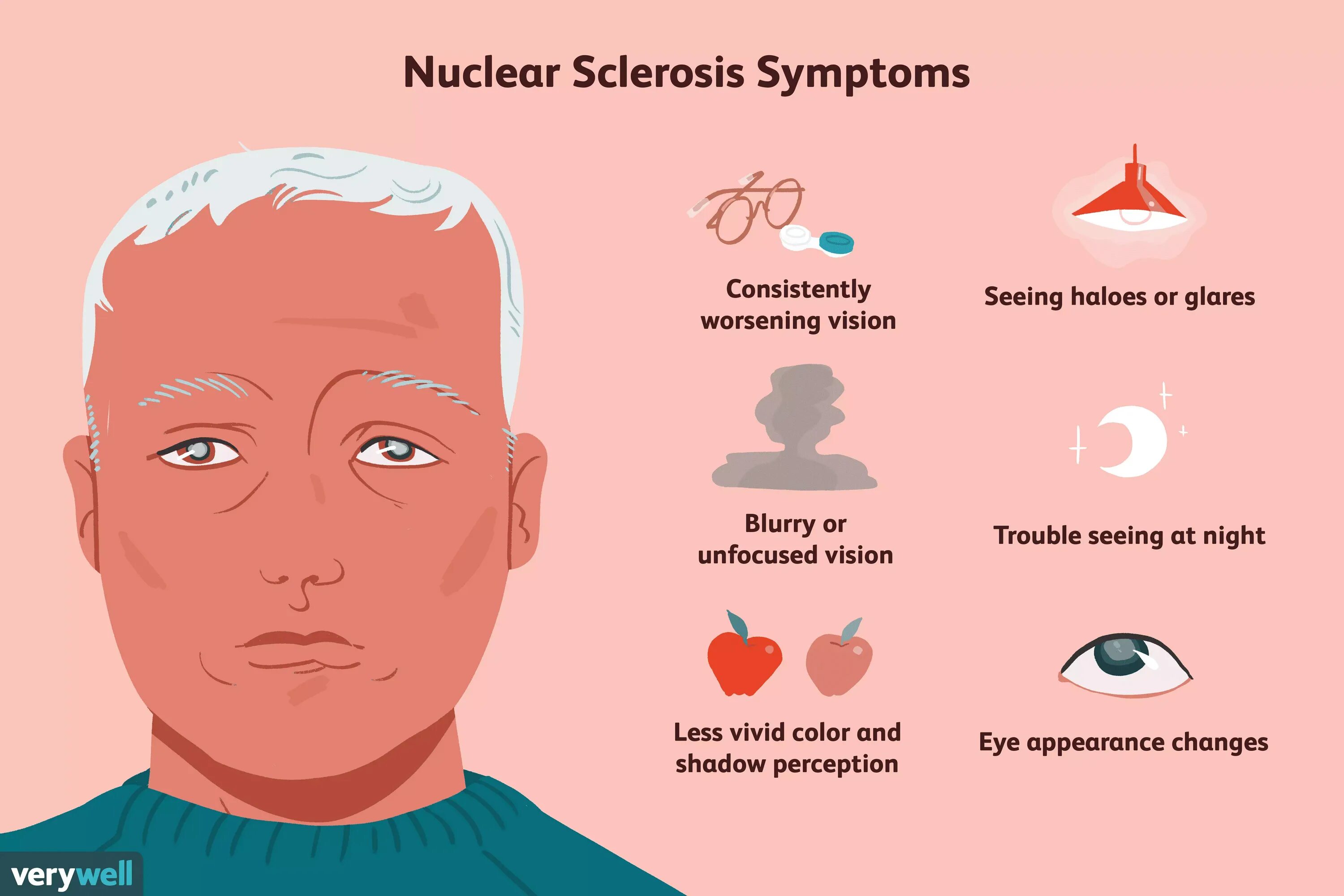 Субальбинотическое глазное дно. Ядерная (бурая) катаракта. Катаракта заднекапсулярная катаракта. Ядерный склероз. Ядерная катаракта фото.