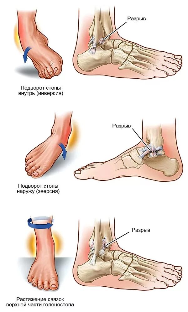 Подвернул ногу щиколотка что делать