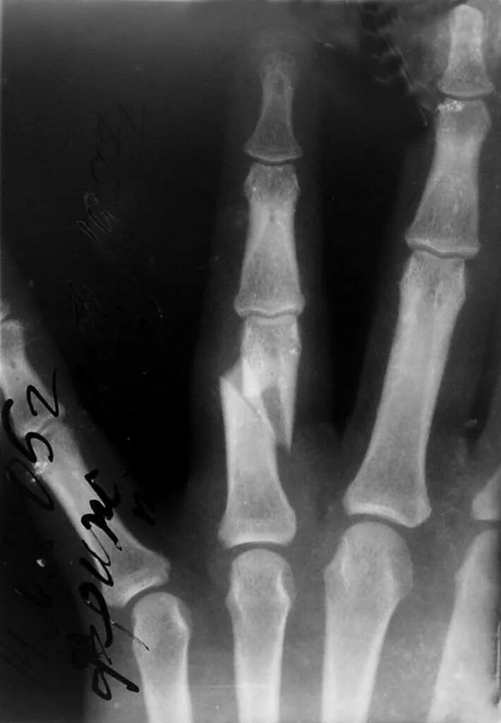 вывих проксимальной фаланги 1 пальца. перелом фаланги кисти рентген. перелом основной фаланги 3 пальца. сломанная фаланга. перелом проксимальной фаланги 4 пальца.