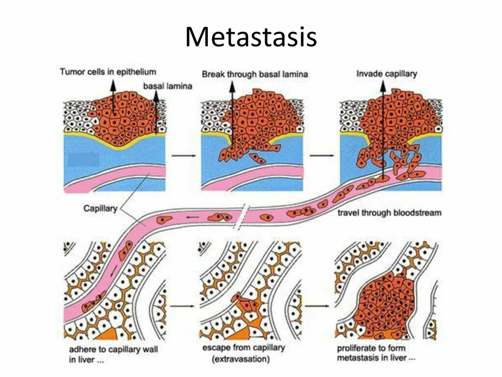 Metastasis. Metastasis process diagram. metastasis steps.