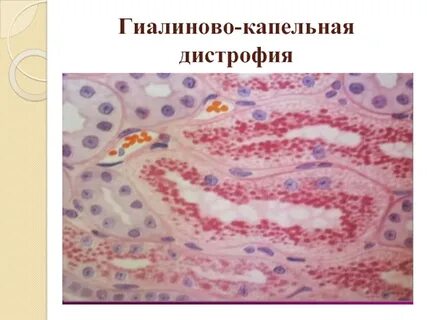 Гиалиново капельная дистрофия