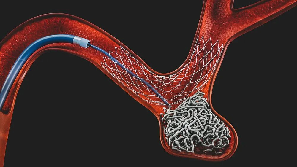 Стентирование аневризмы