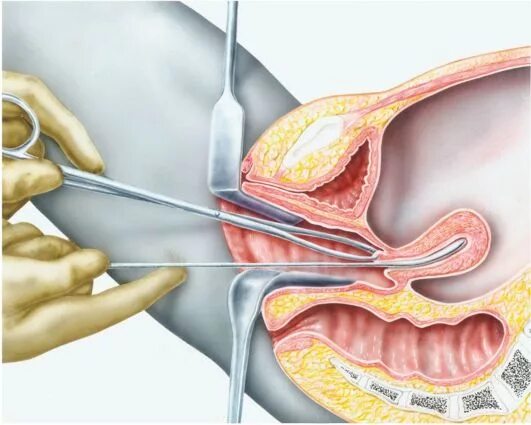 Маточное выскабливание. Аспирационная пайпель биопсия. Что такое пайпель биопсия в гинекологии. Аспирационная биопсия выскабливание.