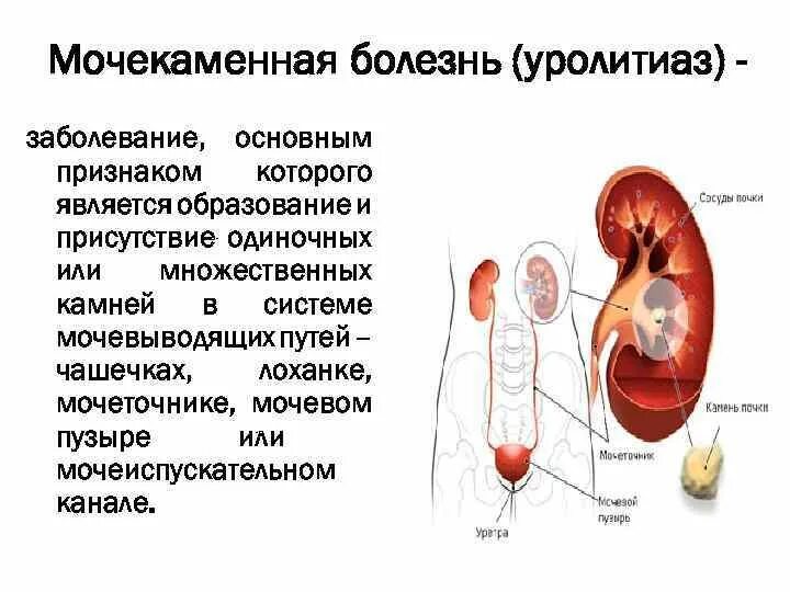 Мочекаменная болезнь (уролитиаз). Мочекаменная болезнь презентация. Заболевание мочекаменная болезнь основные симптомы. Уролитиаз презентация.