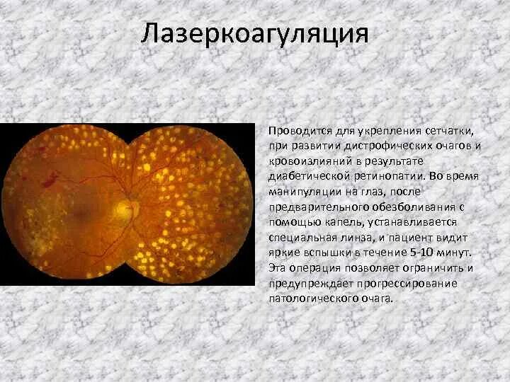 Панретинальная лазеркоагуляция сетчатки. Протокол операции лазерная коагуляция сетчатки. Показания к проведению лазерной фотокоагуляции сетчатки. Отграничительная лазеркоагуляция сетчатки. Фокальная лазеркоагуляция.