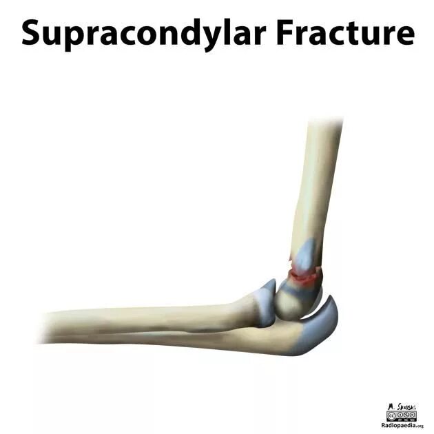 The fracture can be. Supracondylar fracture of humerus in children. transcondylar and supracondylar fractures of the shoulder. epifisis fracture paediatric.