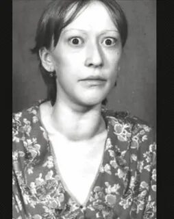 Гипотиреоз токсический зоб