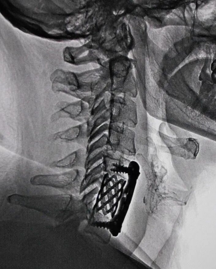 Имплант шейного отдела позвоночника. Передний корпородез с5 с6 Кейджем Solis. Кейдж шейного отдела позвоночника рентген. Кейдж имплант шейного отдела. Межтеловой корпородез с5 с7.