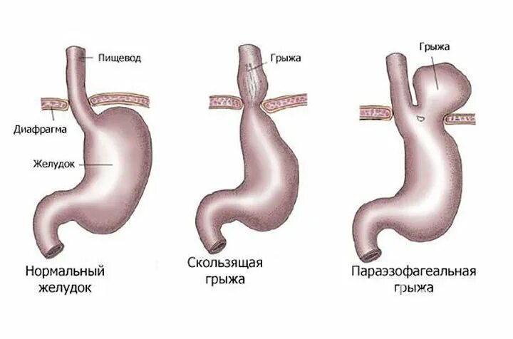 Перед пищеводом. Грыжа 2 степени желудка. Грыжа пищеварительного отверстия диафрагмы. Грыжа желудка 1 степени. Кардиальная грыжа пищевода.