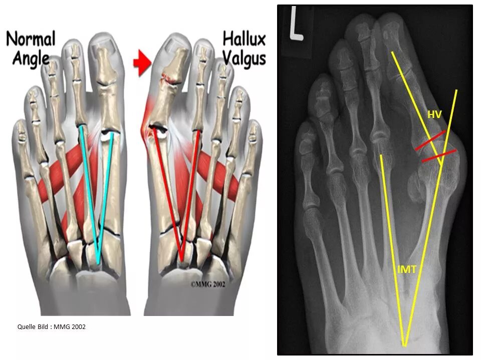 Вальгусная деформация стопы hallux valgus. Халюс вальгус степени на рентгене. Степени вальгусной деформации 1 пальца стопы рентген. Деформация халюс вальгус. Вальгусная операция отзывы