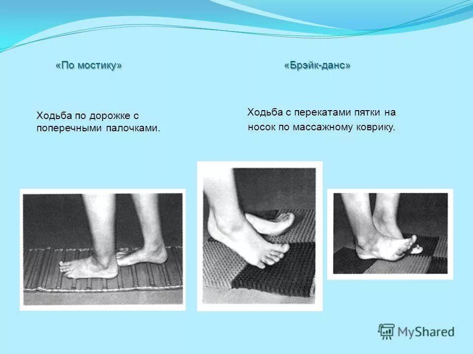 Плосковальгусные стопы операция. Диагноз плоскостопие по мкб 10. Мкб 10 плосковальгусные стопы у детей код. Плосковальгусные стопы у детей мкб код 10. Плосковальгусные стопы у детей мкб код 10.