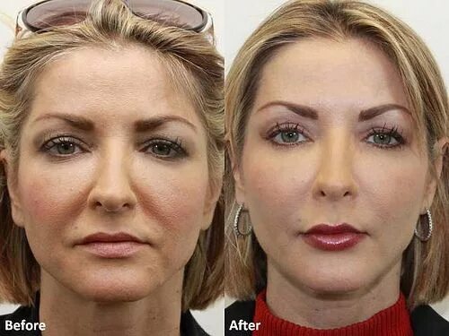 Турбо-страница Ejercicios faciales, Como quitar verrugas, Arrugas