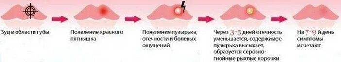 Почему образуются внутренние. Лабиальный герпес (герпес на губах). Герпес стадии развития. Стадии заживления герпеса.