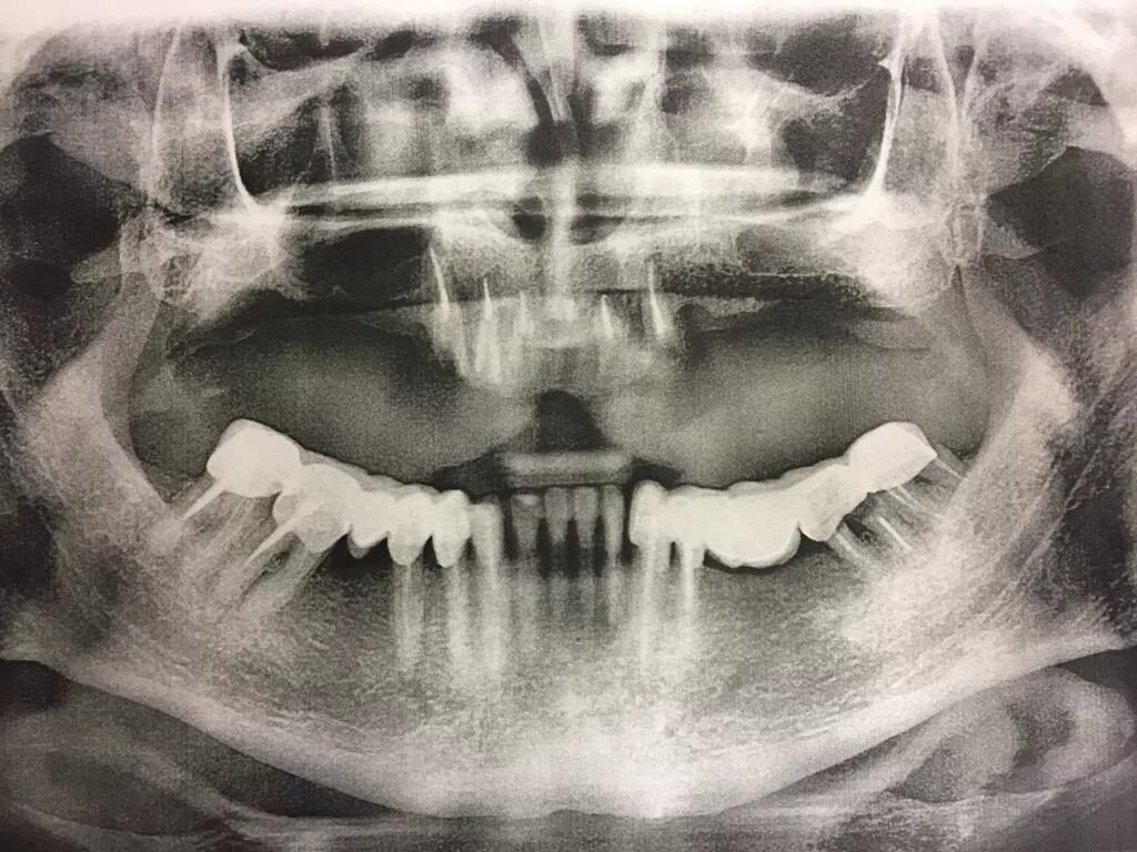 Снимок будут делать. Ортопантомограмма адентия. ОПТГ пародонтит адентия.
