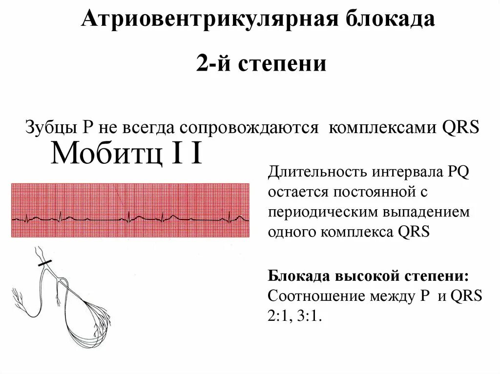 Атриовентрикулярная блокада 2. Атриовентрикулярная блокада Мобитц 1. Антриовентикулчнрч блокада 2 степени. Степени атриовентрикулярной блокады. АВ блокада высокой степени.