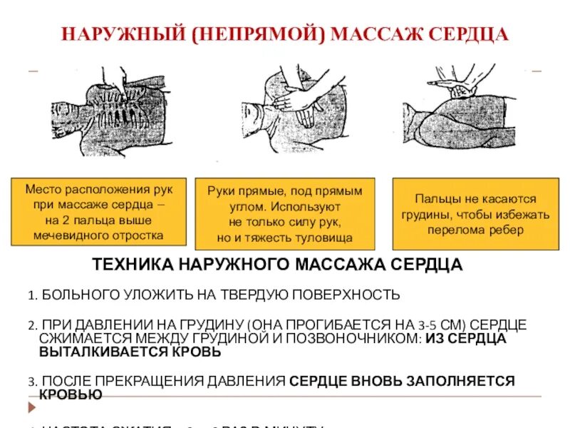 Техника проведения наружного массажа сердца. Наружный массаж сердца методика. Прямой массаж сердца схема. Наружный непрямой массаж сердца. Частота закрытого массажа сердца