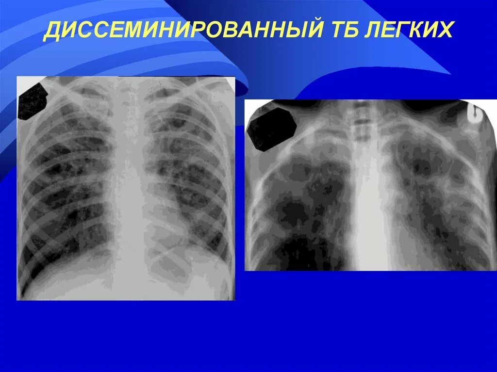 Диссеминация туберкулеза на рентгене. Диссеминированный туберкулез рентген. Лимфогенно диссеминированный туберкулез рентген. Подострый диссеминированный туберкулез рентген. Диссеминированное поражение легких