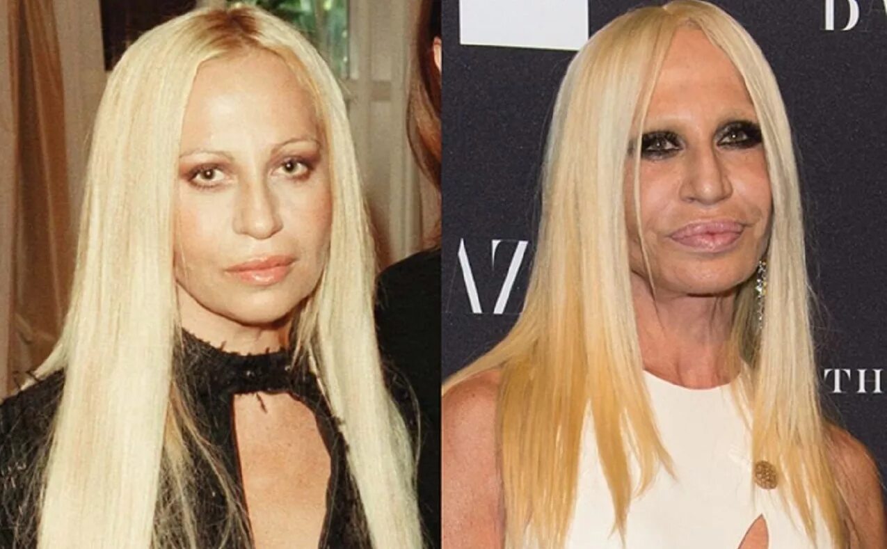 Сестра после операции. Donatella Versace до пластики. Донателла Версаче в молодости. Донателла Версаче пластика. Версаче Донателла Версаче в молодости.