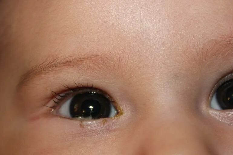 Профилактика глаз новорожденного. Дакриоцистит осложнения конъюнктивит. Дакриоцистит новорожденных дакриоцистит. Дакриоцистит новорожденных слезостояние. Конъюнктивит и дакриоцистит новорожденных.