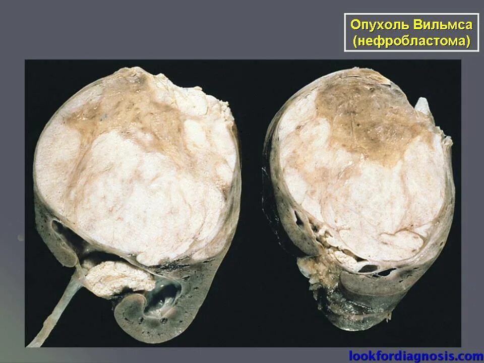 Опухоль Вильмса (нефробластома) макропрепарат. Нефробластома опухоль Вильмса микропрепарат. Нефробластома патанатомия препарат. Опухоль Вильямса патанатомия. Детские опухоли