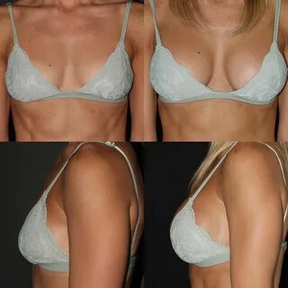 Before After Breast Augmentation utilizing 400cc Moderate Plus Silicone. 