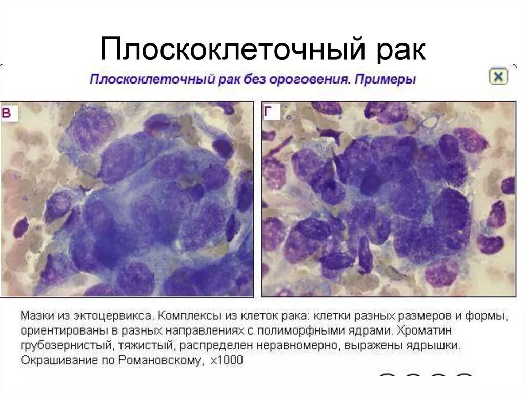 Плоскоклеточная карцинома шейки матки гистология. Базалиома цитологическое исследование. Фиброзирующая базалиома. Базалиома кожи цитология гистология. Группы клеток метаплазированного